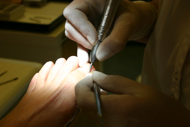 Trattamento podologico professionale presso Podosan